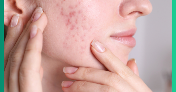 Mụn Nội Tiết Có Tự Hết Không?  Dấu Hiệu Nhận Biết Và Cách Điều Trị Hiệu Quả 